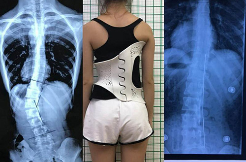 3D打印技術(shù)在骨科的實(shí)際應(yīng)用有哪些？(圖4)